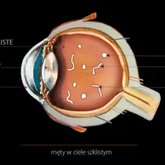  Męty w oku - jak je usunąć i zapobiec ich powstawaniu? Skuteczne metody leczenia.